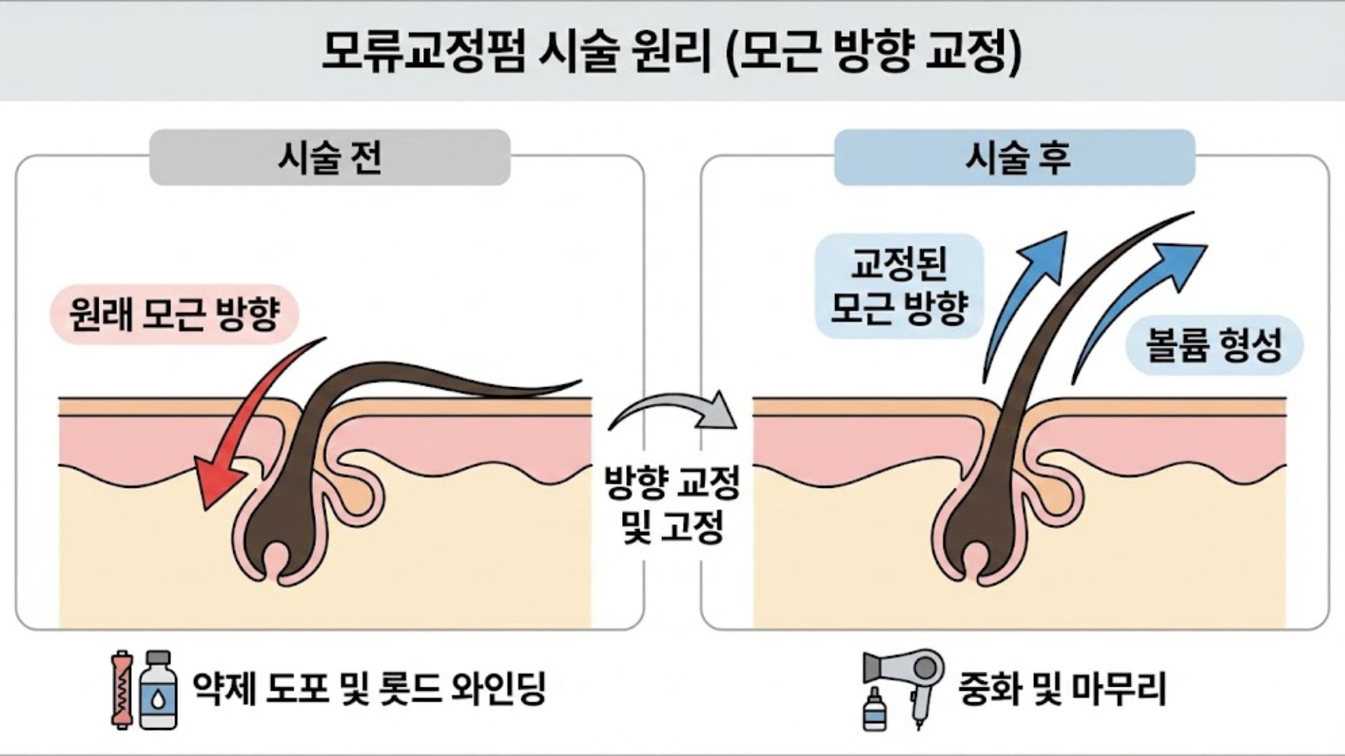 모류교정펌 시술 원리를 보여주는 모근 방향 교정 다이어그램