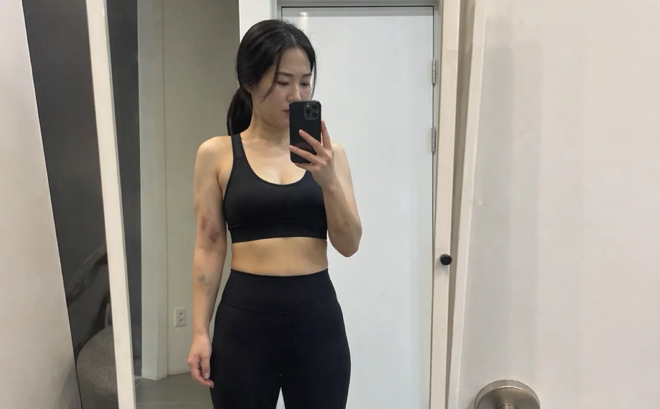 수면마취 없이 군살만 쏙쏙 뽑아내는 일상 복귀가 빠른 람스팔뚝 시술 과정